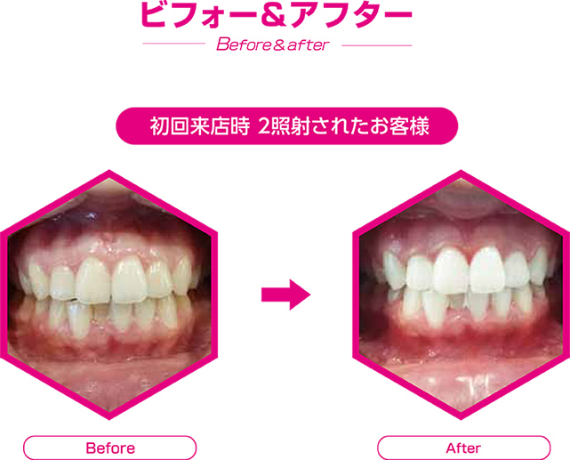 セルフホワイトニングのビフォーアフター画像
